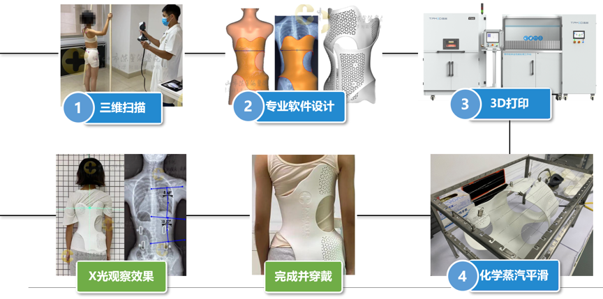 SLS 3D打印脊柱侧弯矫形器制作流程